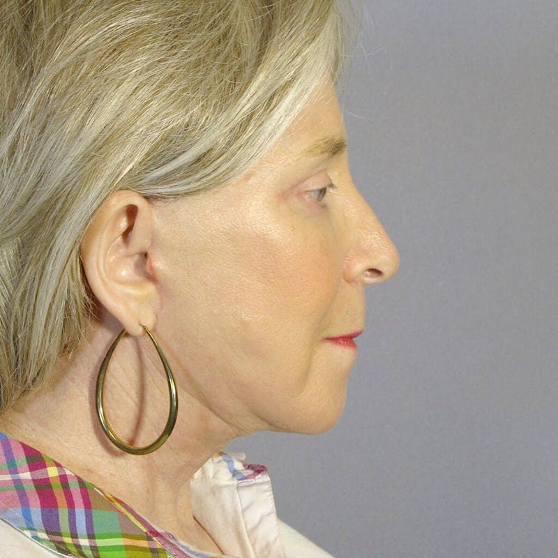 Facelift Before & After Gallery - Patient 391503 - Image 6