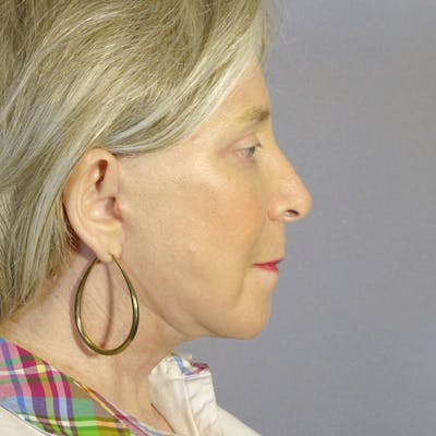 Facelift Before & After Gallery - Patient 391503 - Image 6
