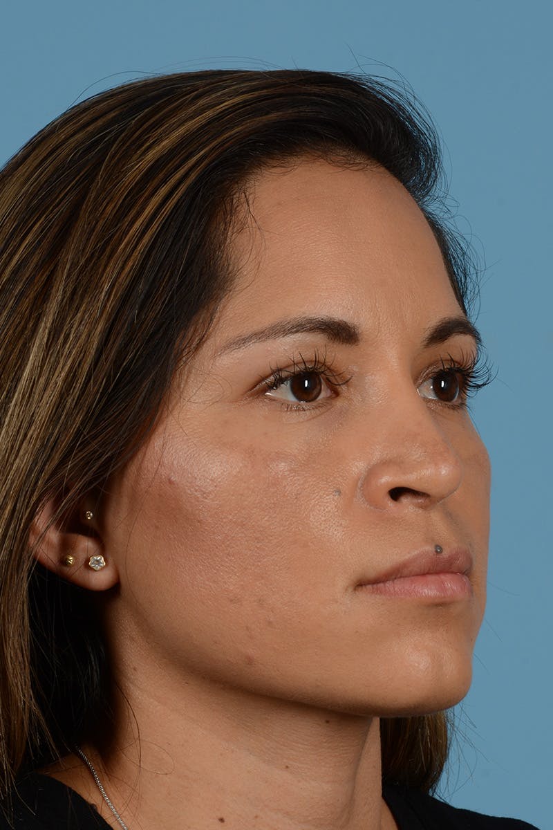 Rhinoplasty Before & After Gallery - Patient 221419 - Image 4