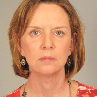 Facelift Before & After Gallery - Patient 362713 - Image 2