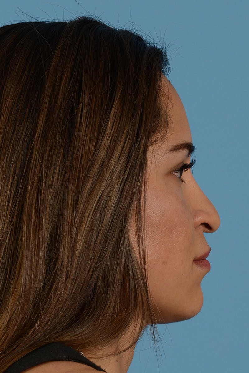 Rhinoplasty Before & After Gallery - Patient 221419 - Image 5