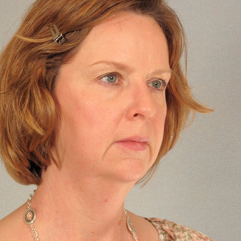 Facelift Before & After Gallery - Patient 362713 - Image 3