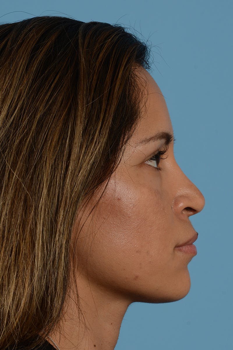 Rhinoplasty Before & After Gallery - Patient 221419 - Image 6