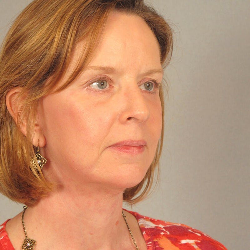 Facelift Before & After Gallery - Patient 362713 - Image 4