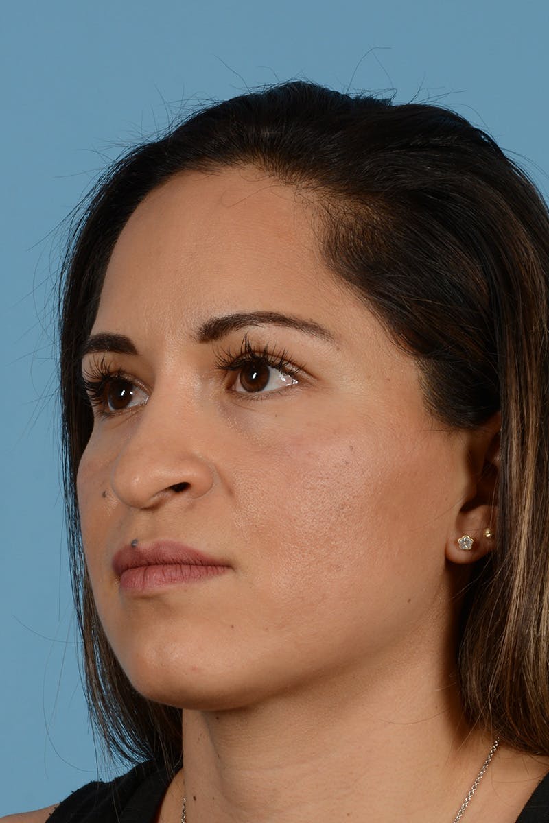 Rhinoplasty Before & After Gallery - Patient 221419 - Image 7