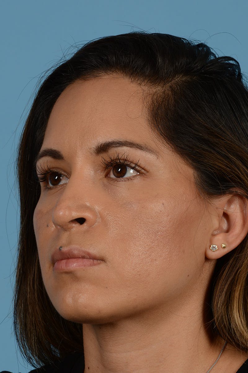 Rhinoplasty Before & After Gallery - Patient 221419 - Image 8