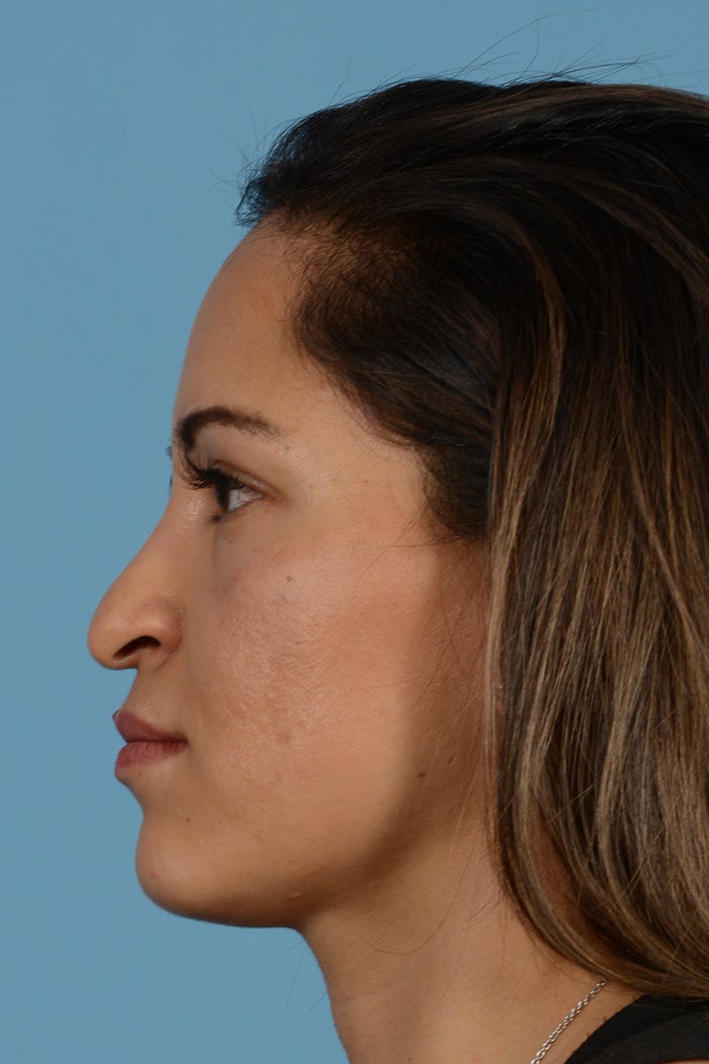 Rhinoplasty Before & After Gallery - Patient 221419 - Image 9
