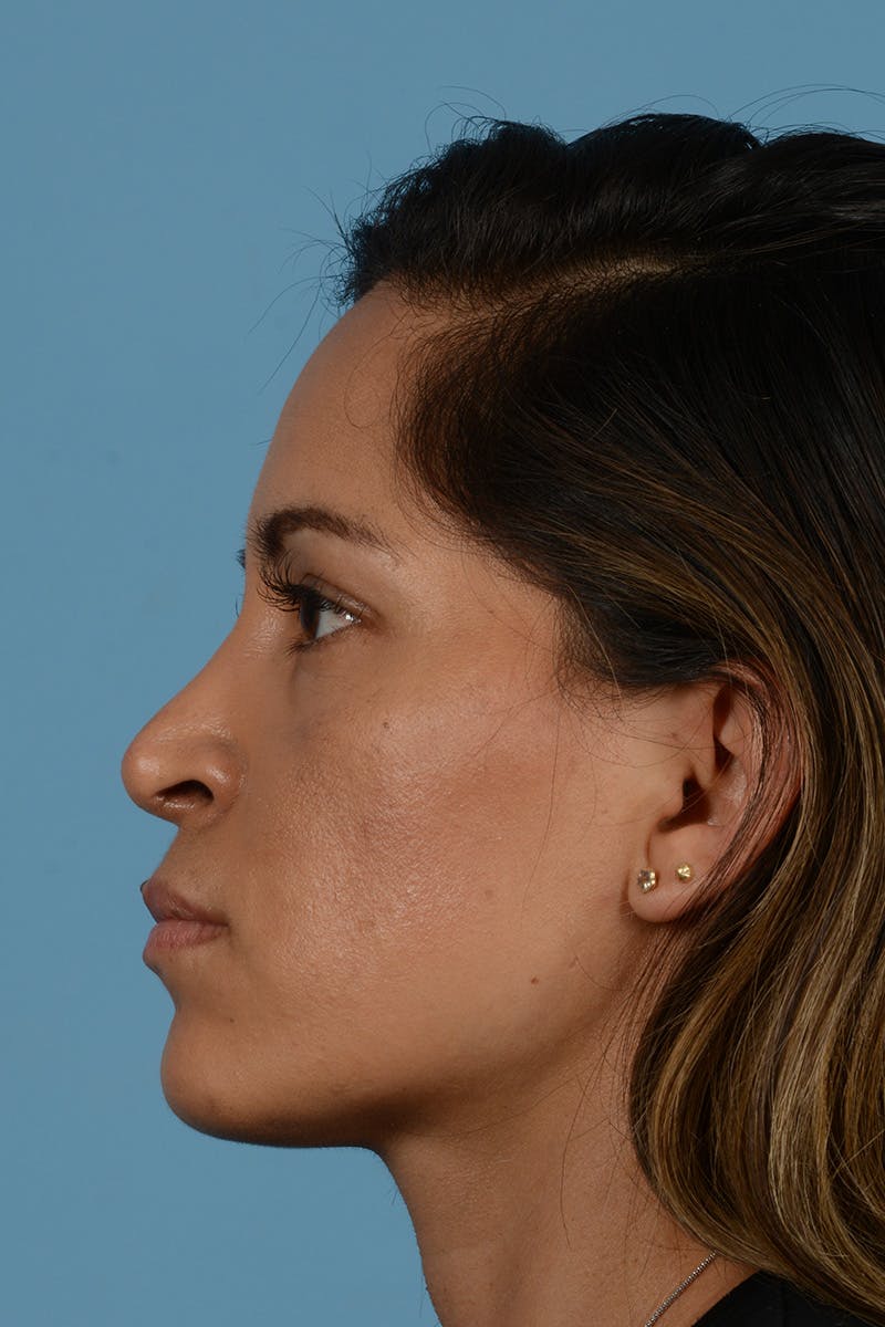 Rhinoplasty Before & After Gallery - Patient 221419 - Image 10