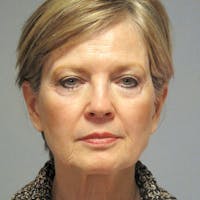 Facelift Before & After Gallery - Patient 404147 - Image 1