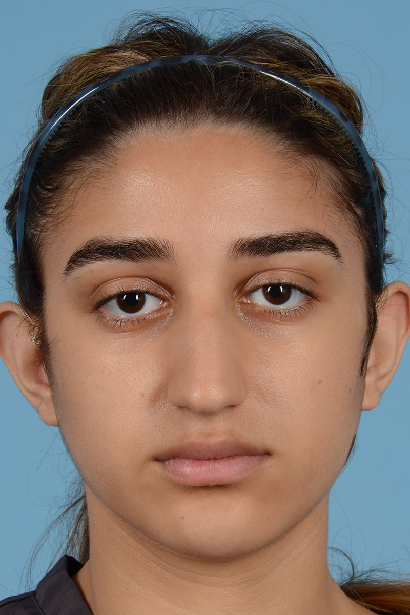 Rhinoplasty Before & After Gallery - Patient 252722 - Image 1
