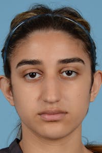 Rhinoplasty Before & After Gallery - Patient 252722 - Image 1