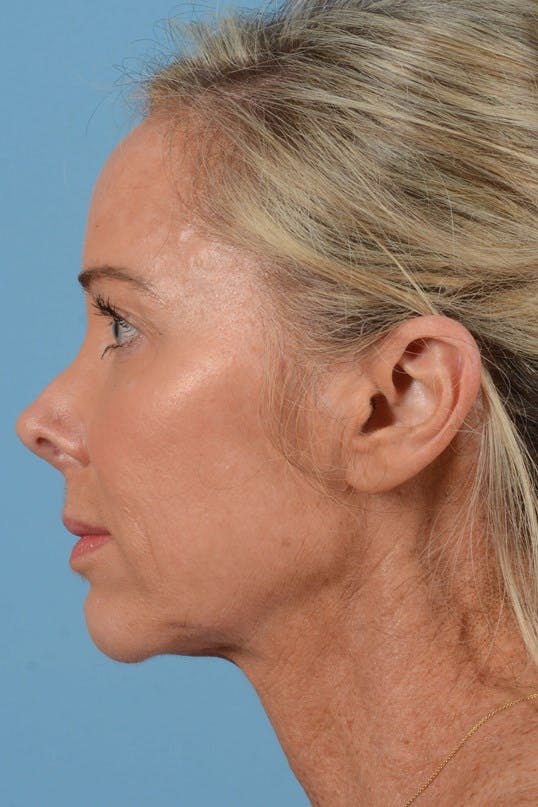 Neck Lift Before & After Gallery - Patient 191168 - Image 9