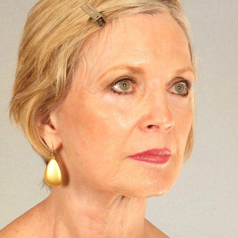 Facelift Before & After Gallery - Patient 404147 - Image 4