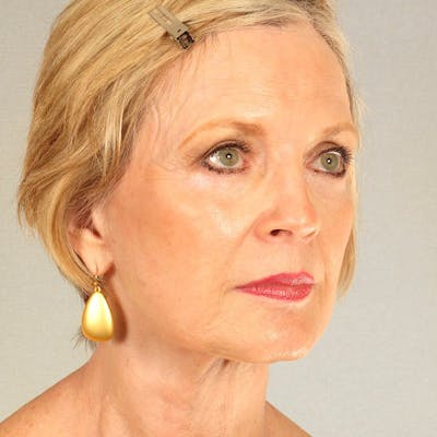 Facelift Before & After Gallery - Patient 404147 - Image 4
