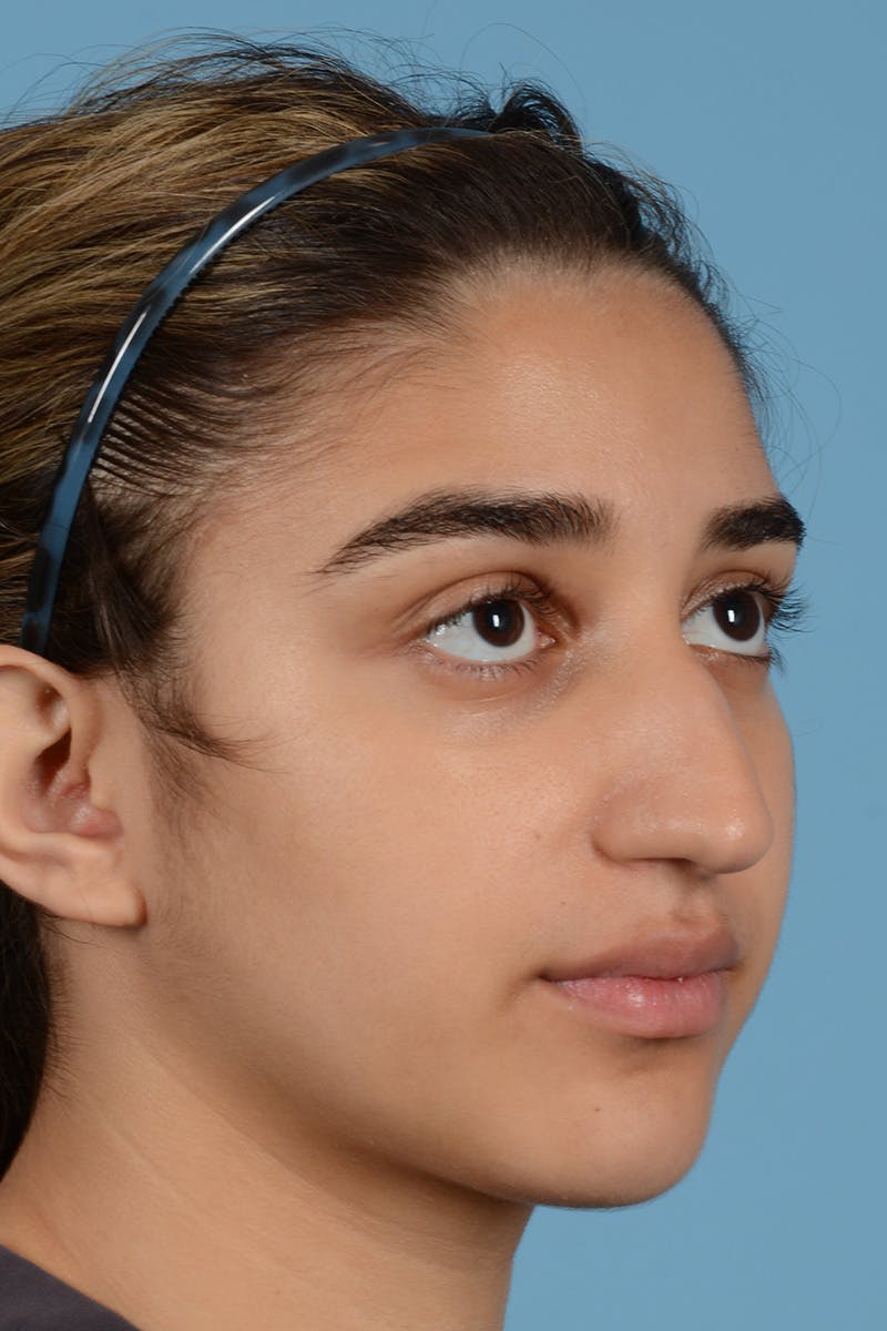 Rhinoplasty Before & After Gallery - Patient 252722 - Image 3