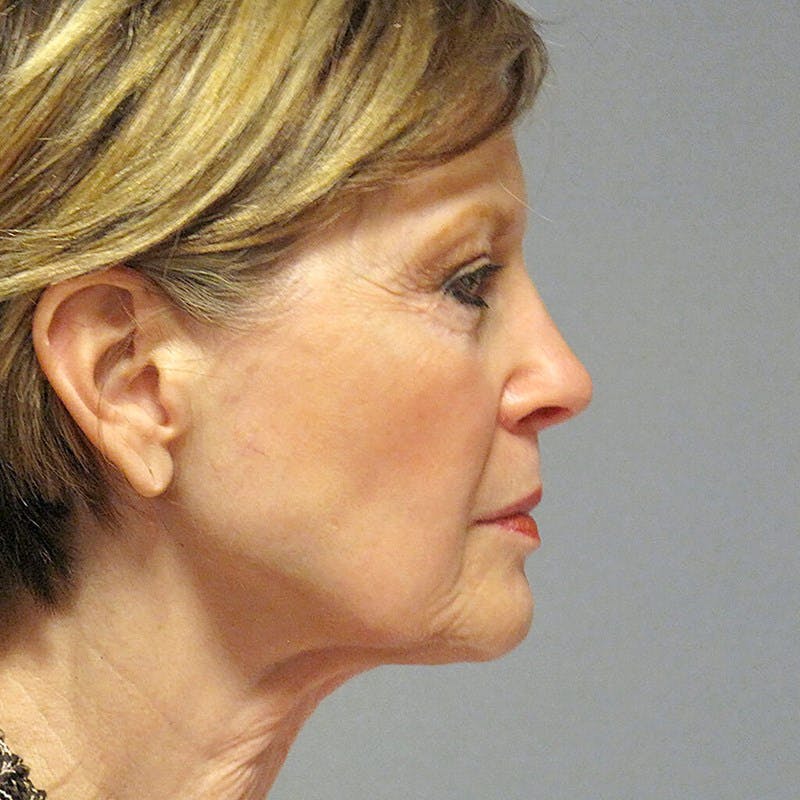 Facelift Before & After Gallery - Patient 404147 - Image 5