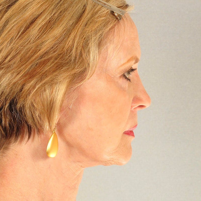 Facelift Before & After Gallery - Patient 404147 - Image 6
