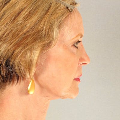 Facelift Before & After Gallery - Patient 404147 - Image 6
