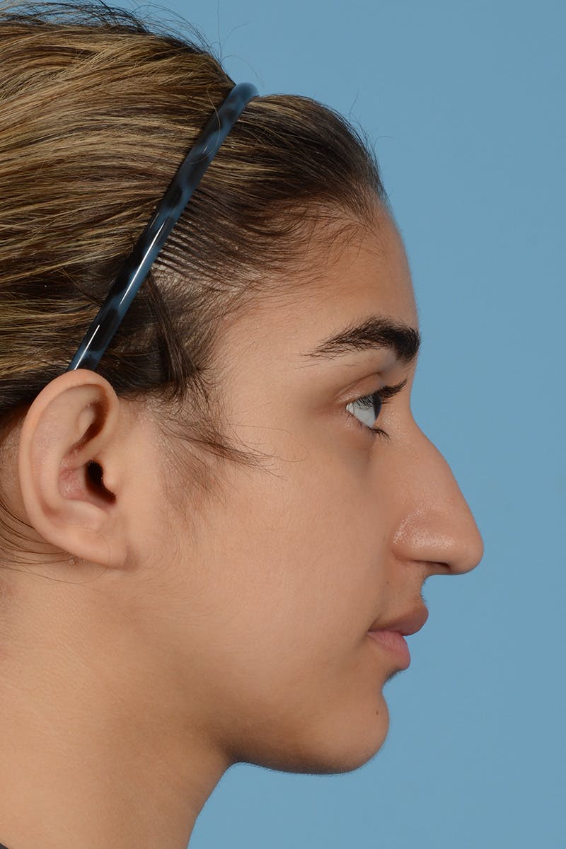Rhinoplasty Before & After Gallery - Patient 252722 - Image 5