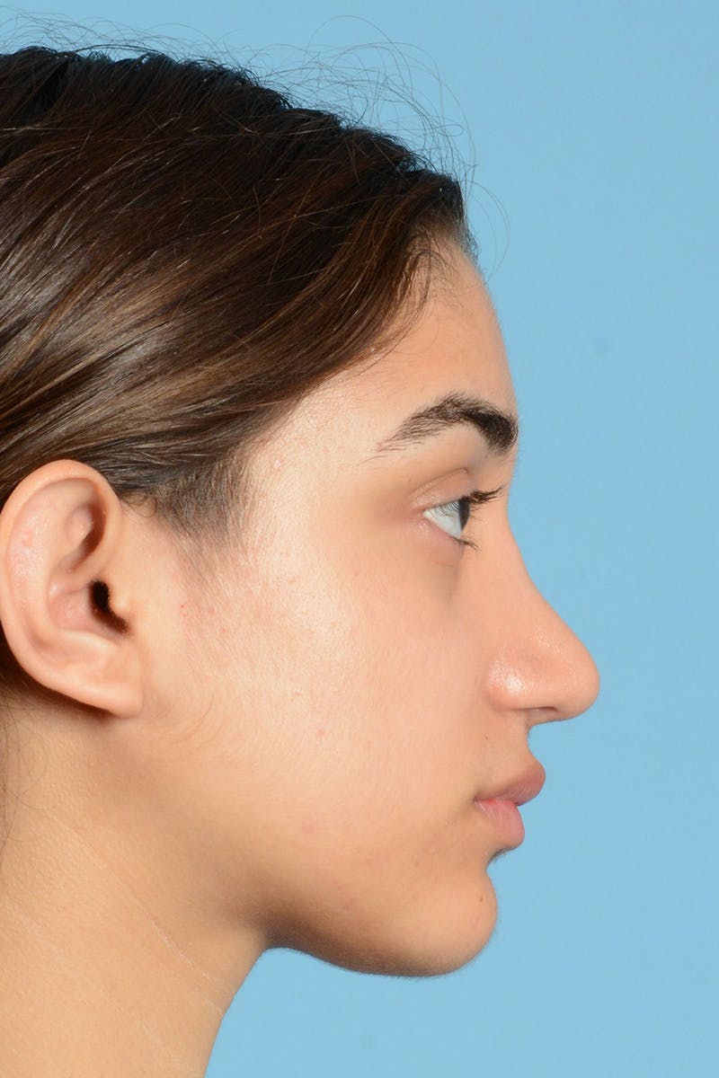 Rhinoplasty Before & After Gallery - Patient 252722 - Image 6