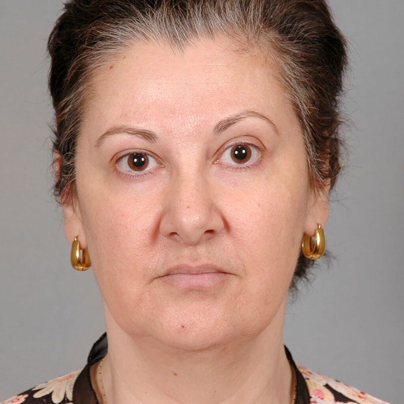 Facelift Before & After Gallery - Patient 115559 - Image 1