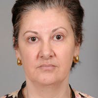 Facelift Before & After Gallery - Patient 115559 - Image 1