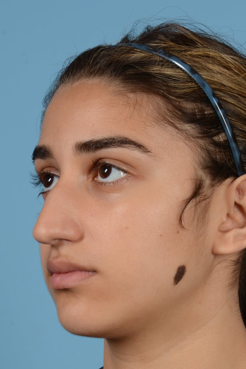 Rhinoplasty Before & After Gallery - Patient 252722 - Image 7