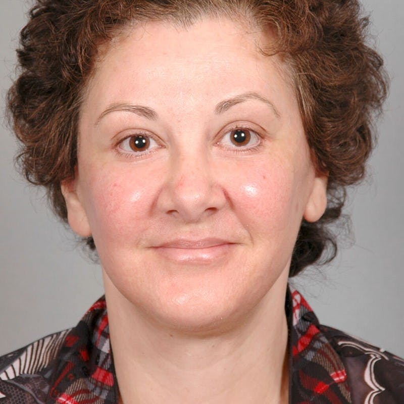 Facelift Before & After Gallery - Patient 115559 - Image 2