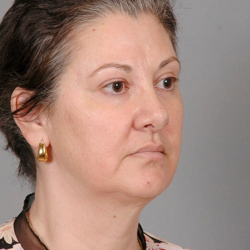 Facelift Before & After Gallery - Patient 115559 - Image 3