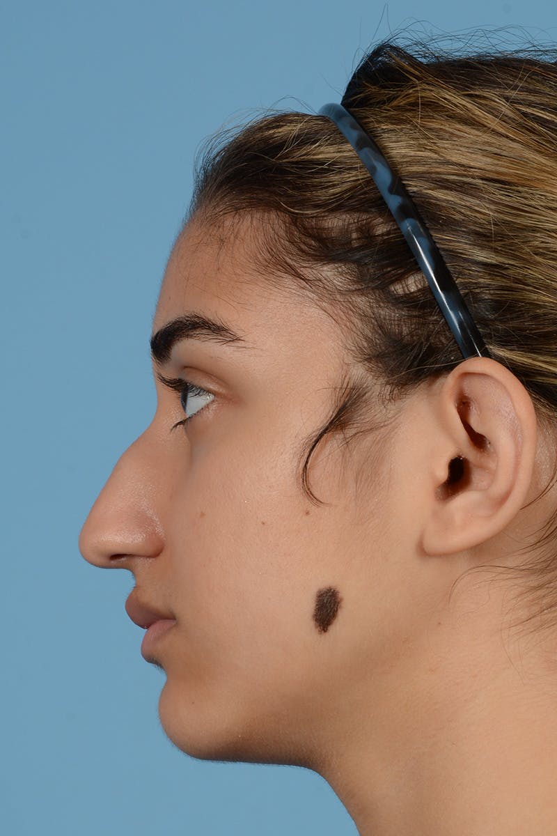 Rhinoplasty Before & After Gallery - Patient 252722 - Image 9