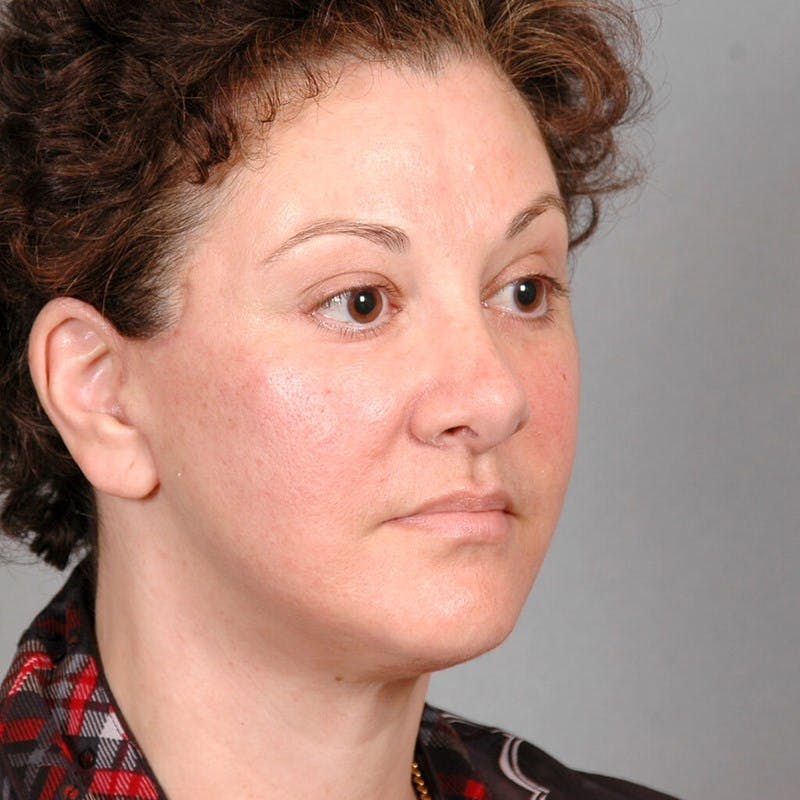 Facelift Before & After Gallery - Patient 115559 - Image 4