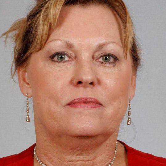 Facelift Before & After Gallery - Patient 186302 - Image 1