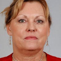 Facelift Before & After Gallery - Patient 186302 - Image 1