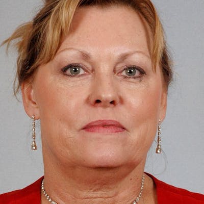 Facelift Before & After Gallery - Patient 186302 - Image 1