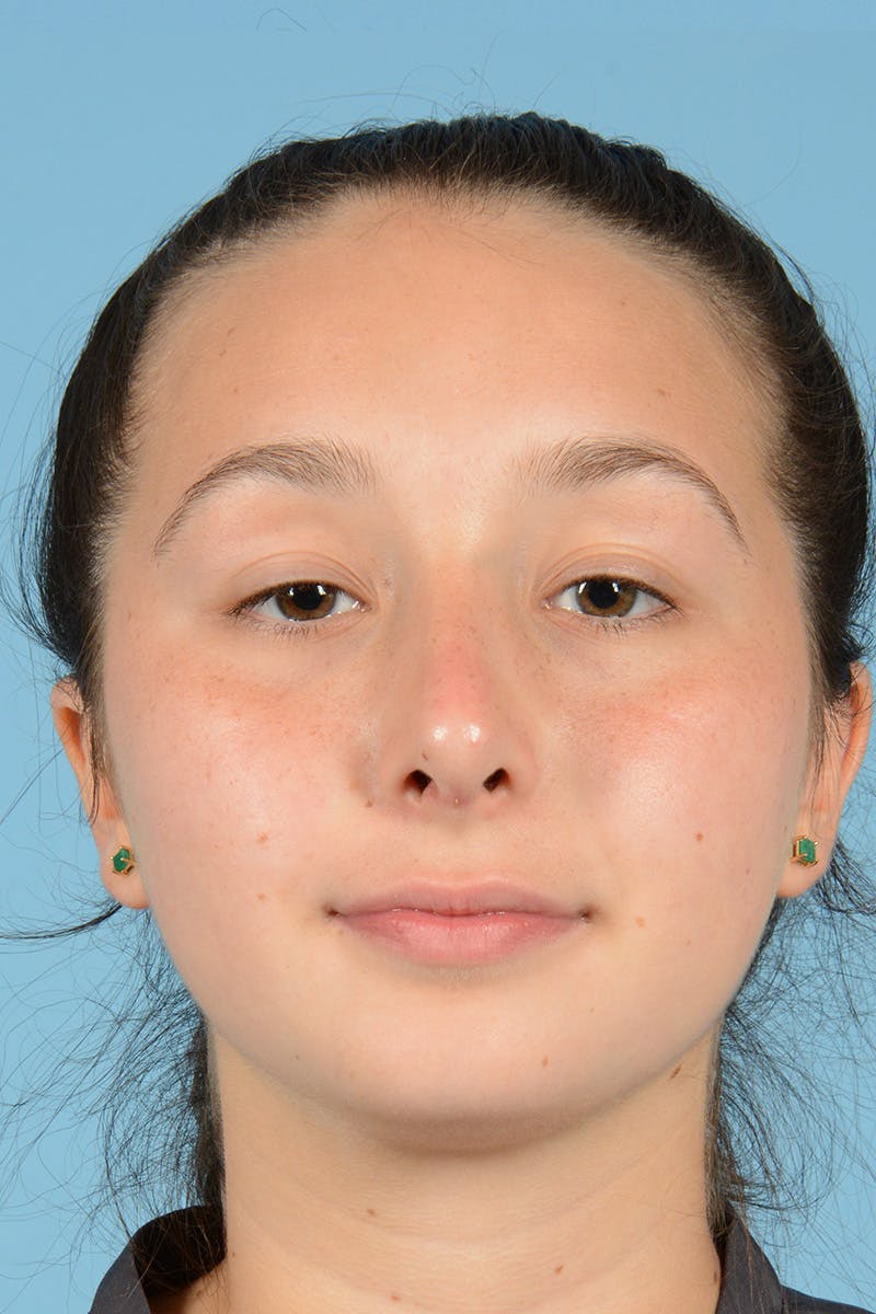 Rhinoplasty Before & After Gallery - Patient 240530 - Image 2