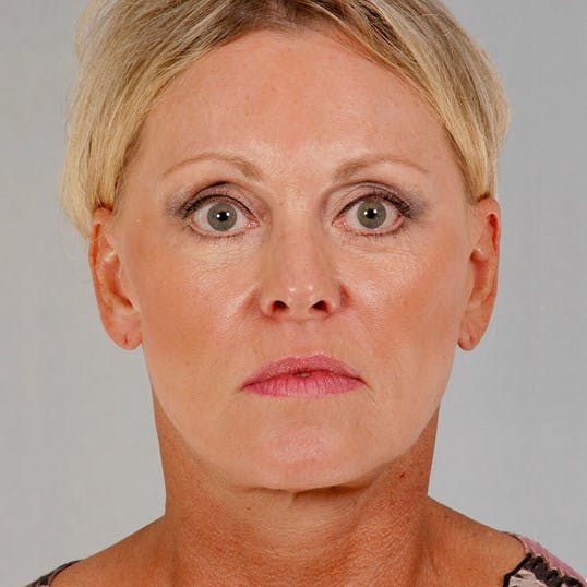 Facelift Before & After Gallery - Patient 186302 - Image 2