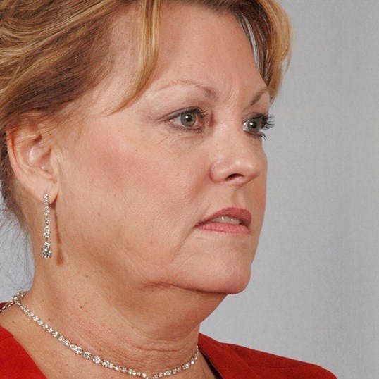 Facelift Before & After Gallery - Patient 186302 - Image 3