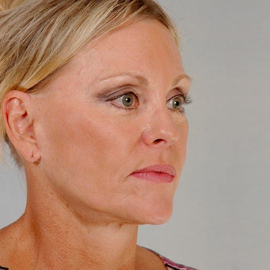 Facelift Before & After Gallery - Patient 186302 - Image 4