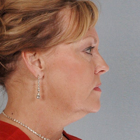 Facelift Before & After Gallery - Patient 186302 - Image 5