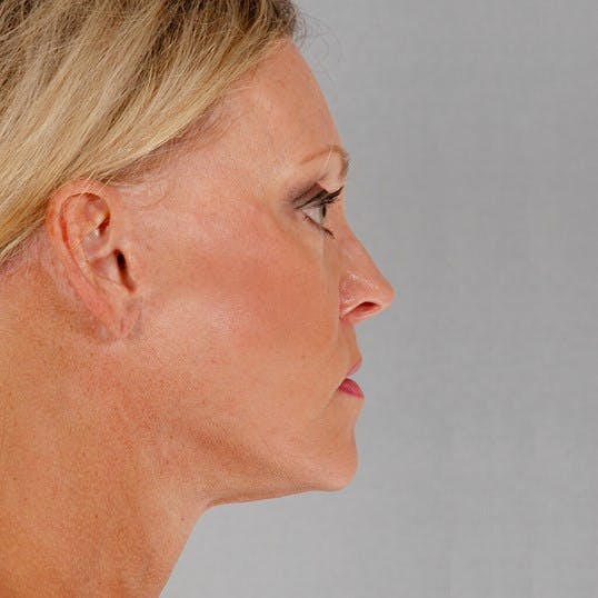 Facelift Before & After Gallery - Patient 186302 - Image 6