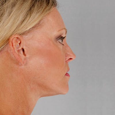 Facelift Before & After Gallery - Patient 186302 - Image 6