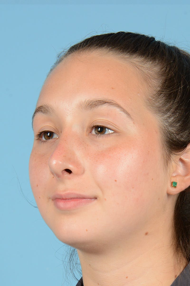 Rhinoplasty Before & After Gallery - Patient 240530 - Image 8