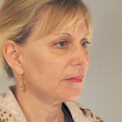 Facelift Before & After Gallery - Patient 417692 - Image 4