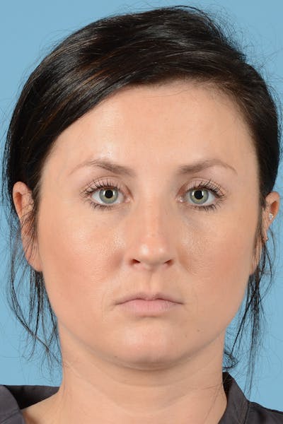 Rhinoplasty Before & After Gallery - Patient 284204 - Image 1