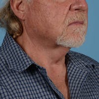 Neck Lift Before & After Gallery - Patient 428494 - Image 1