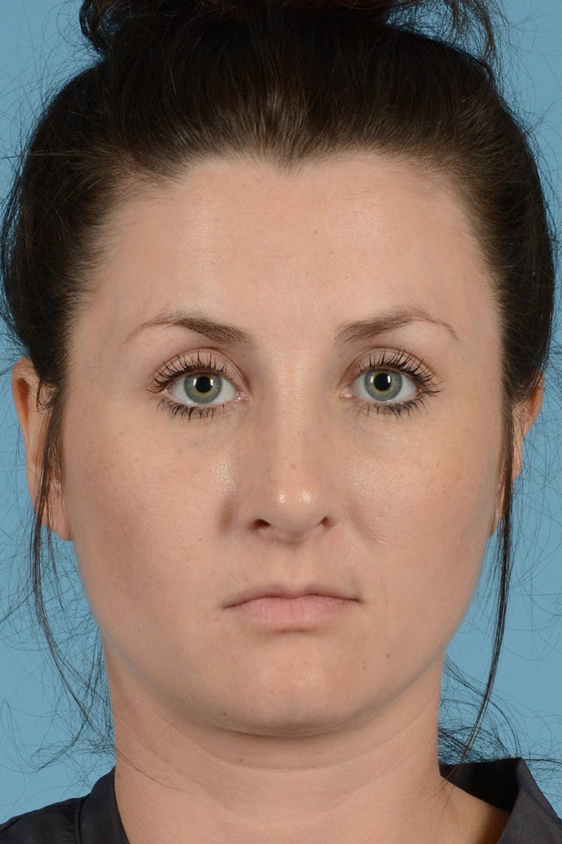 Rhinoplasty Before & After Gallery - Patient 284204 - Image 2