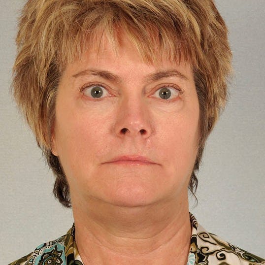 Facelift Before & After Gallery - Patient 256884 - Image 1