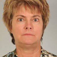 Facelift Before & After Gallery - Patient 256884 - Image 1
