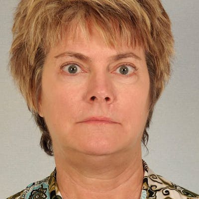 Facelift Before & After Gallery - Patient 256884 - Image 1