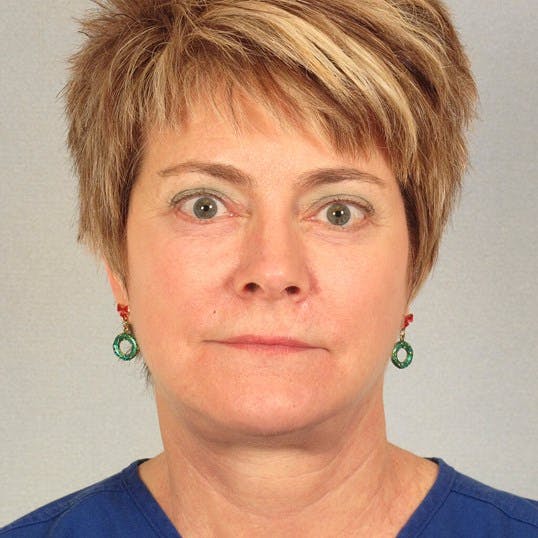 Facelift Before & After Gallery - Patient 256884 - Image 2